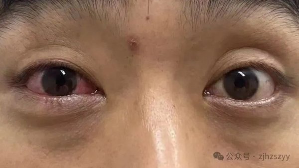 国汇策略 杭州男子进山遇到五步蛇，想抓来玩，结果被喷一脸毒！